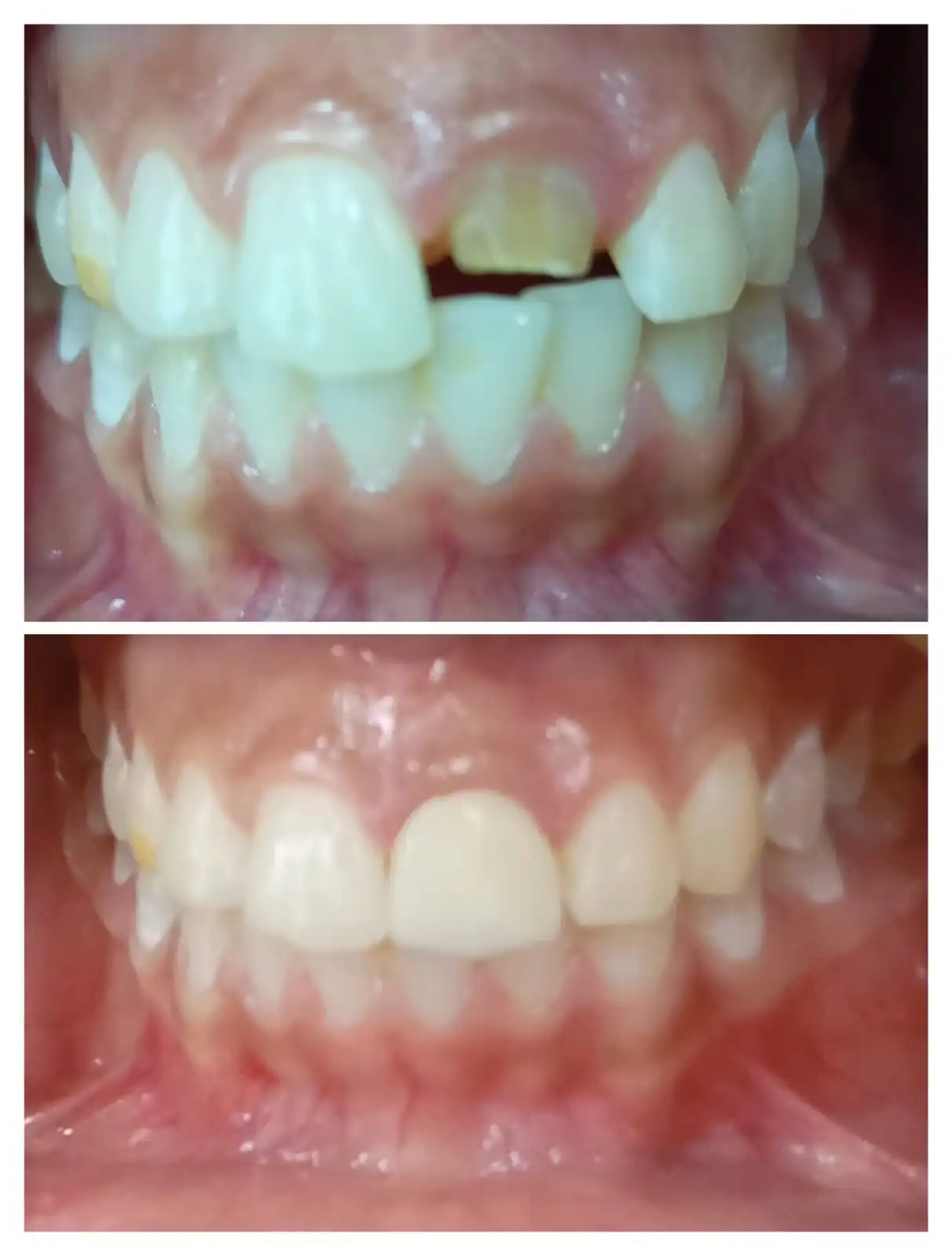 Anterior Smile Correction #10