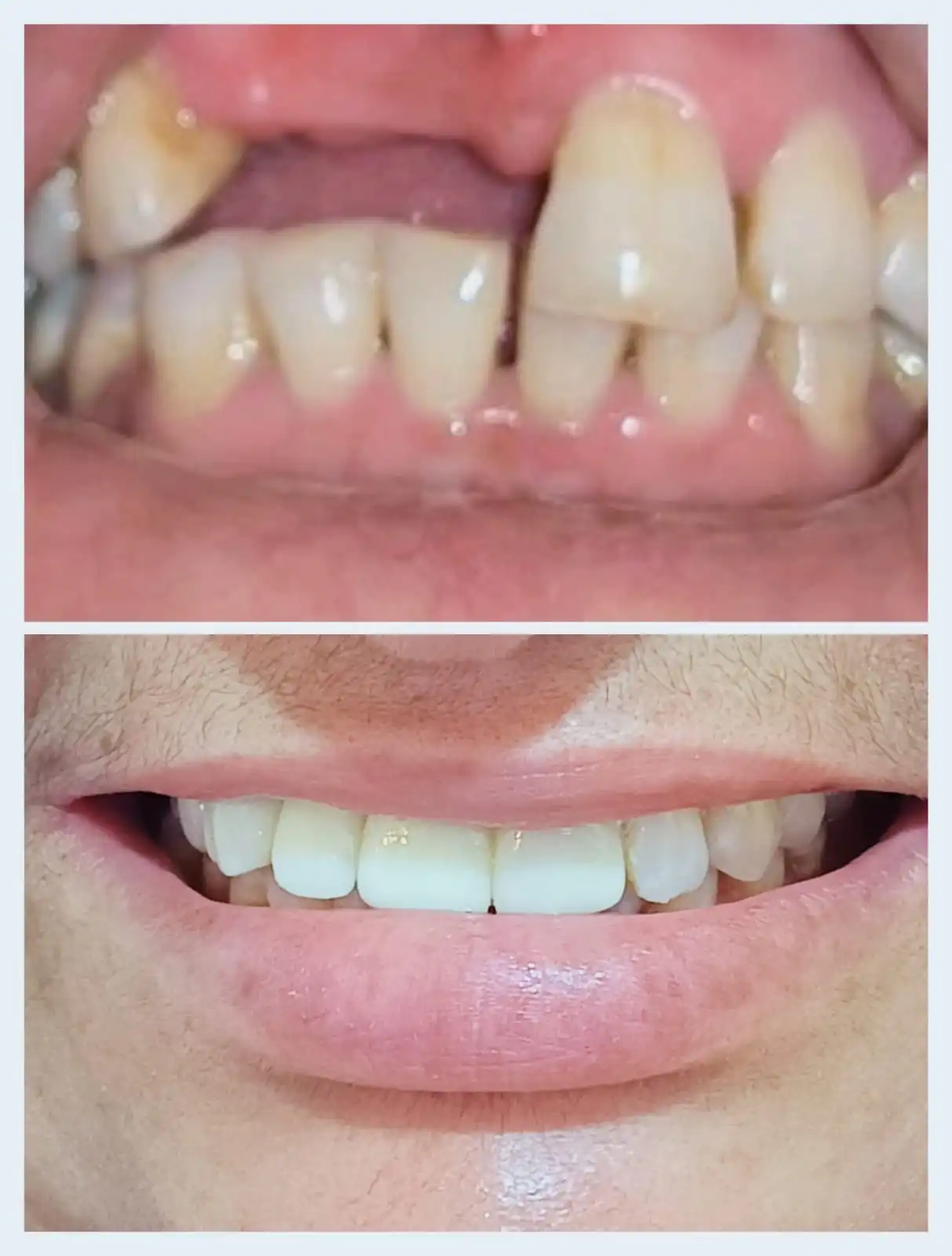 Anterior Smile Correction #9