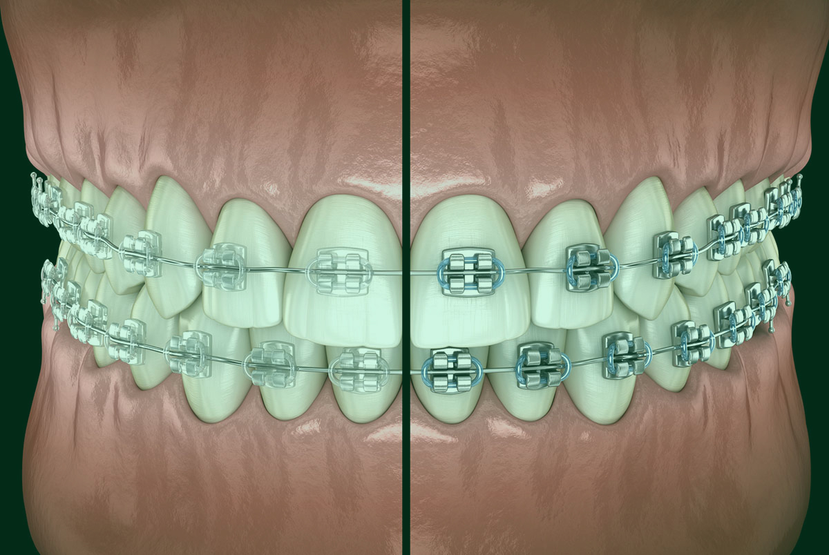 Orthodontic Treatment