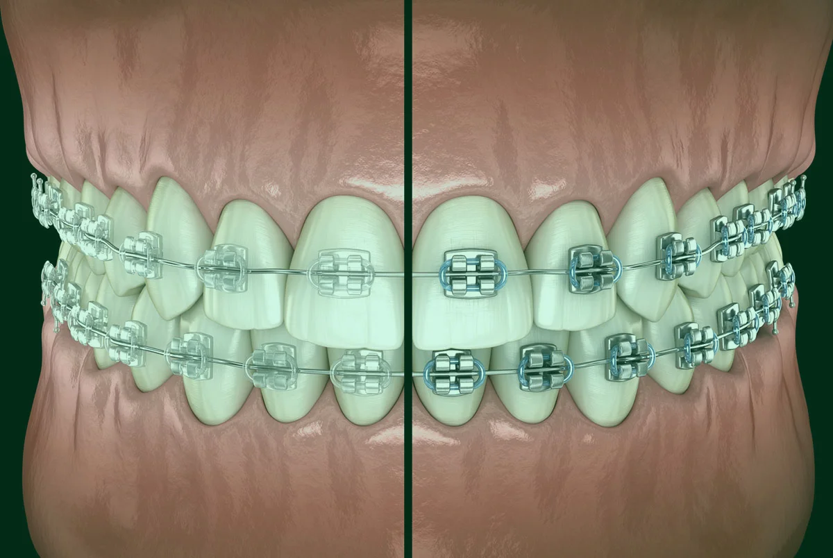 Orthodontic Treatment