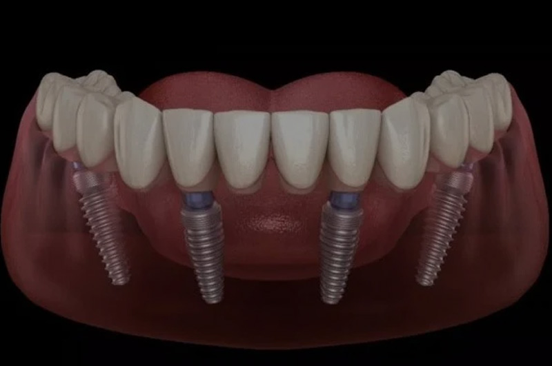 Full Mouth Implants