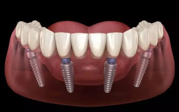 Full Mouth Implant