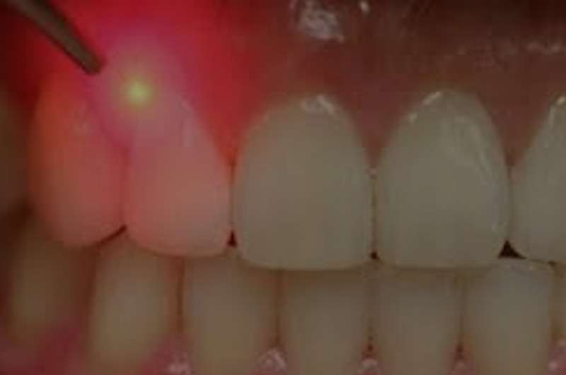 Laser Gum Surgery