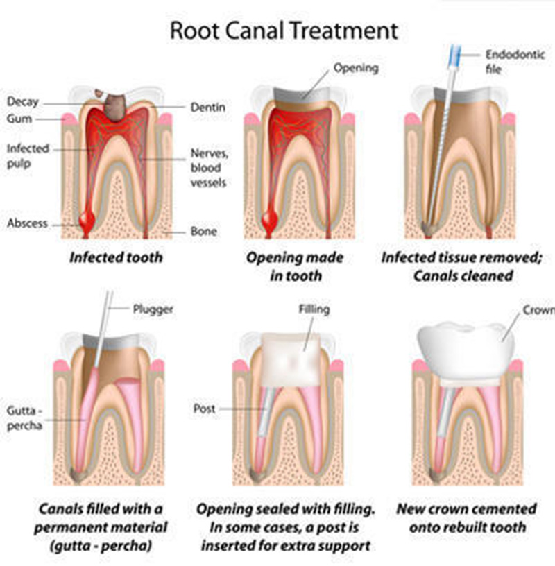 Root Canal Treatment